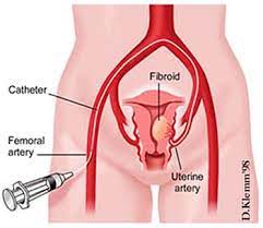 Uterine Artery Embolization