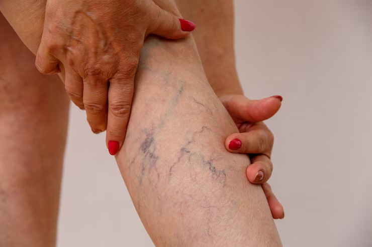 Prevention Strategies For Varicose Veins: Lifestyle Modifications And Compression Therapy