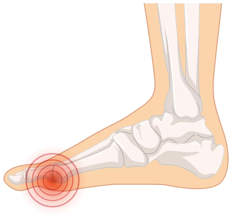 Gangrene In Special Populations: Understanding Risk Factors And Challenges