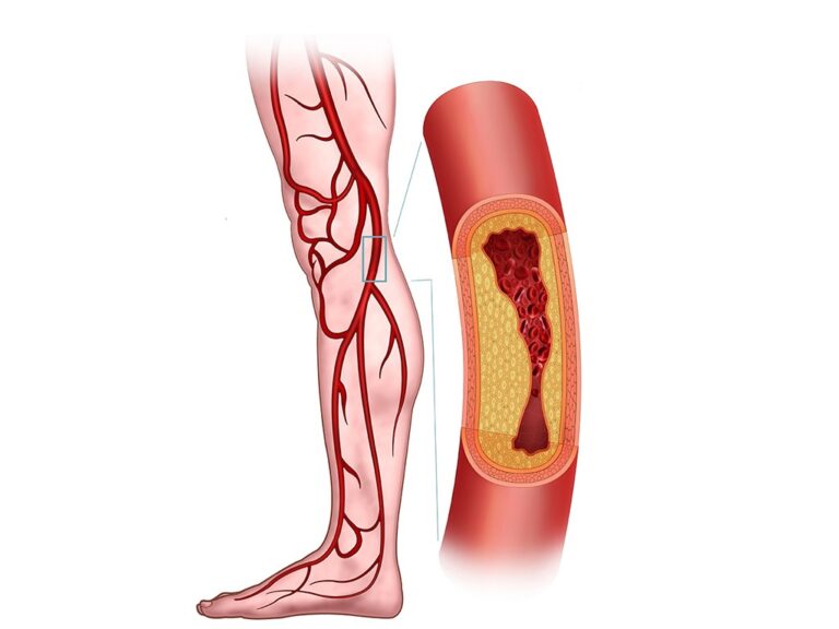 Advancements In Endovascular Surgery: Innovations And Emerging Technologies