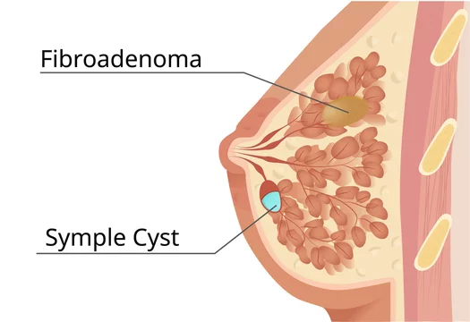 Hormonal Influences On Breast Fibroadenoma Development And Growth