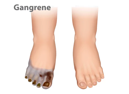 Gangrene Rehabilitation: Enhancing Quality Of Life After Tissue Loss