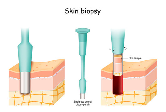 Advancements In Biopsy Technology And Techniques