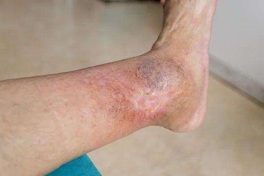 The Role Of Compression Therapy In Managing Leg Ulcers