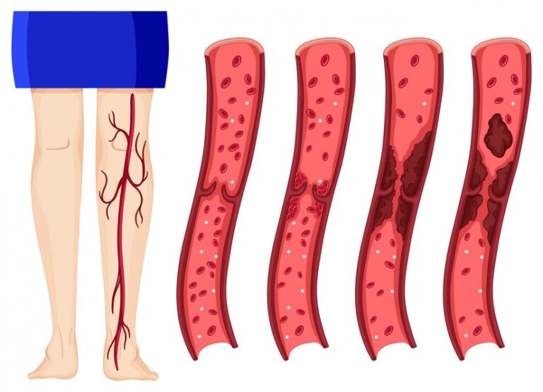 Varicose Veins And Compression Therapy: Benefits And Best Practices