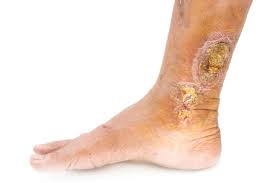 Leg Ulcer Treatment in Noida