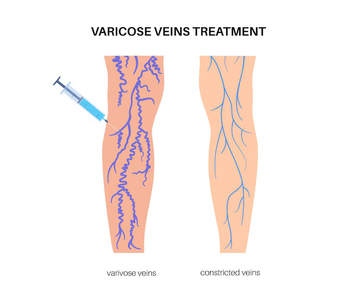 Varicose vein specialists in Noida