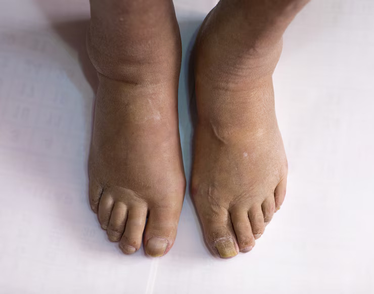 Diabetic Foot Treatment in Noida