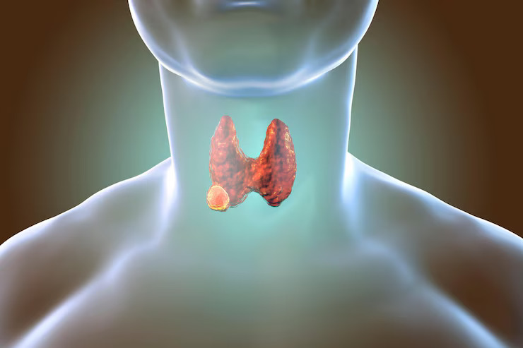 Thyroid Nodule Treatment in Sector 79