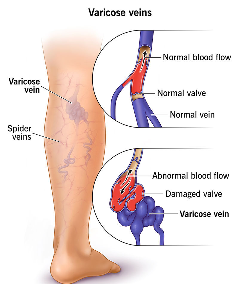 Varicose Vein Specialist in Sector 101