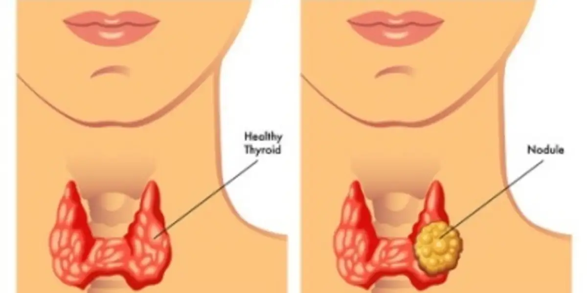 Thyroid Nodule Treatment in Sector 101