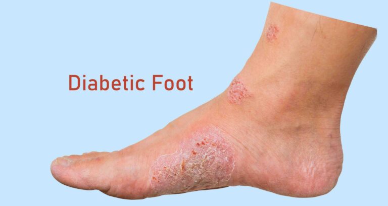 Diabetic foot Treatment in Sector 79