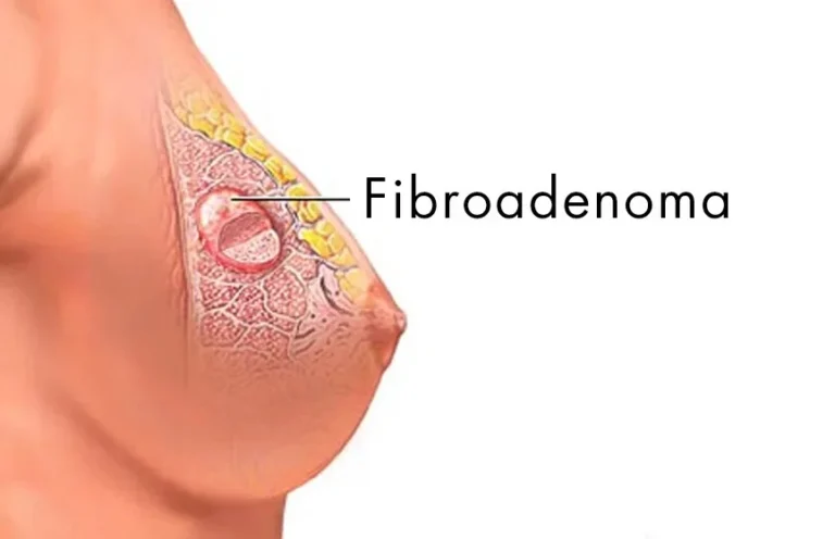 Breast Fibroadenoma Treatment in Sector 101