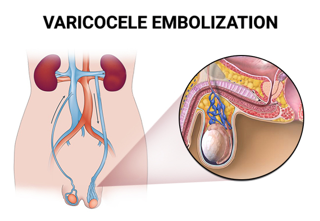 Best Varicocele embolization Treatment in Sector 79