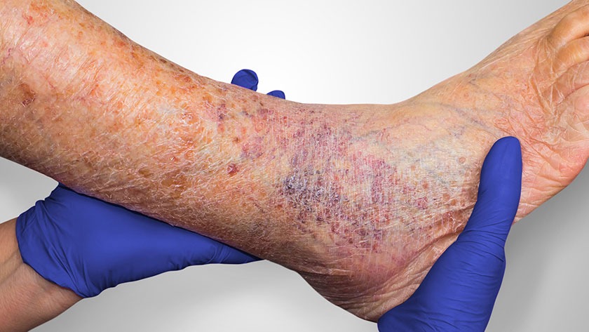 Best Leg Ulcer Treatment in Sector 79, Noida