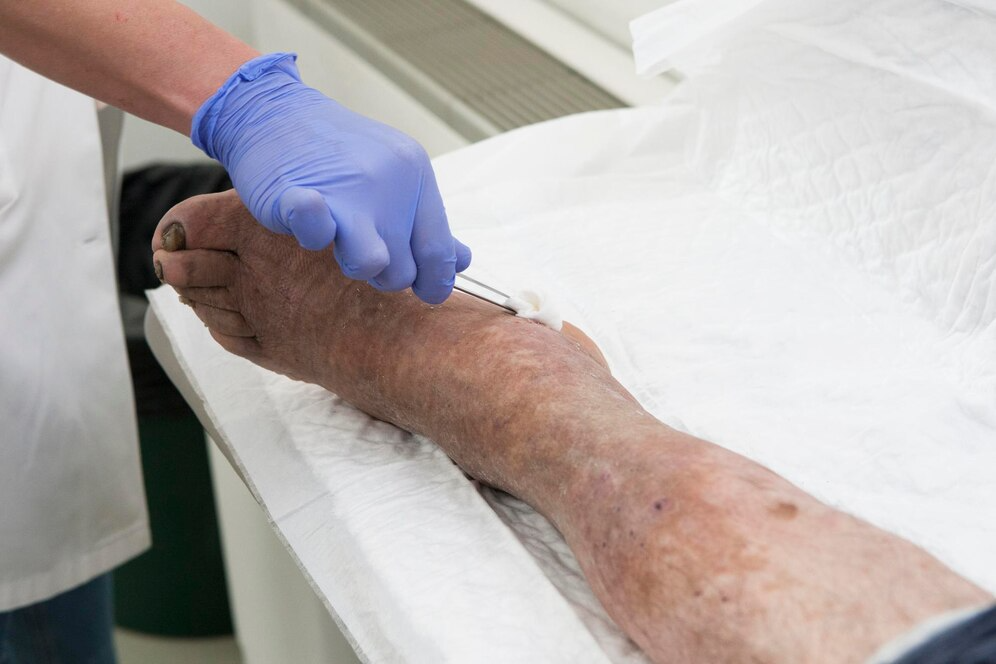 Best Varicose vein specialist in Noida