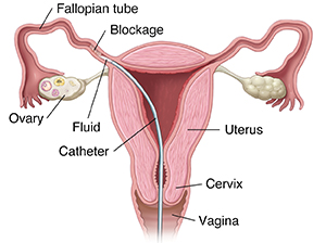 Best Fallopian Tube Recanalization in Sector 71, Noida