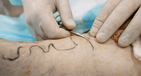 Best Varicose vein specialist in Sector 71, Noida