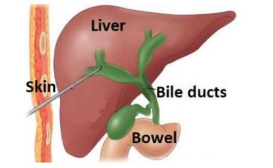 Best percutaneous transhepatic biliary drainage in Sector 71