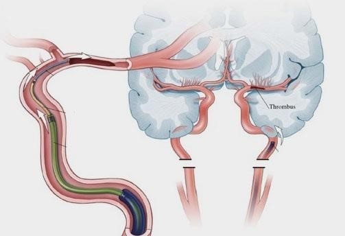 Best Mechanical Thrombectomy Treatment in Sector 71, Noida