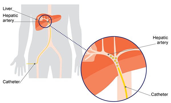 Best TACE Procedure for Liver Cancer in Sector 71, Noida