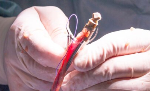 Best Uterine artery Embolization in Noida
