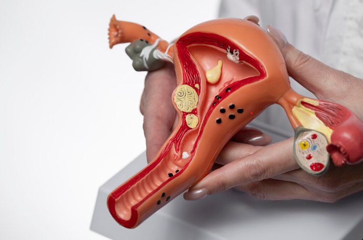 Best Doctor for Uterine Fibroid Embolization in Noida