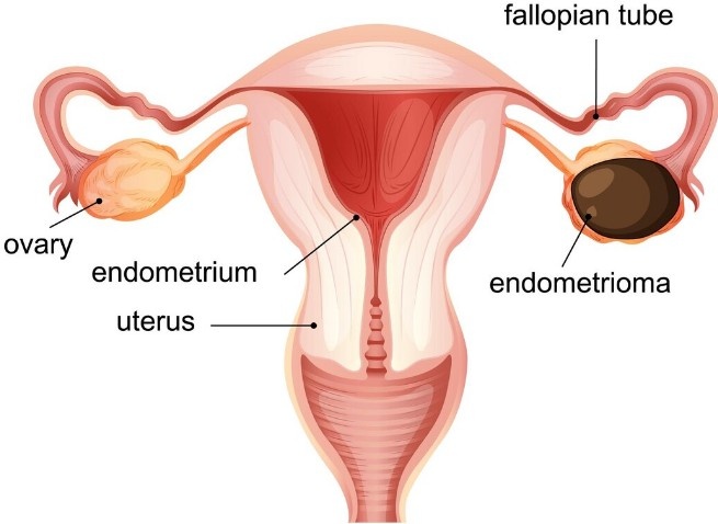 Best Doctors for Fallopian Tube Recanalization in Noida