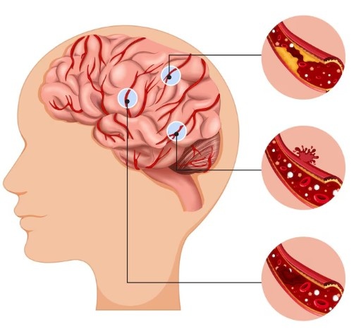 Best Doctor for Aneurysm Coiling in Noida
