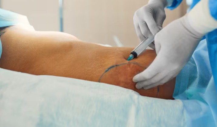 Best Varicose Vein Doctor in Noida