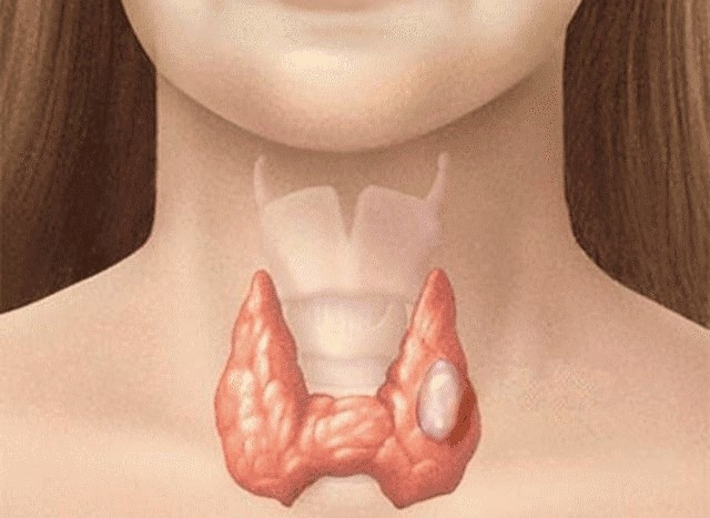 Best Thyroid Nodule Specialists in Noida