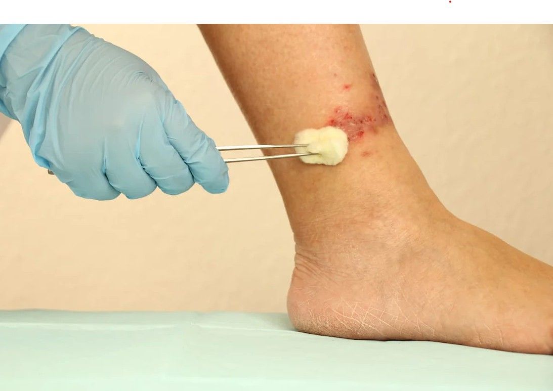 Best Leg Ulcer Specialist in Noida Sector 71