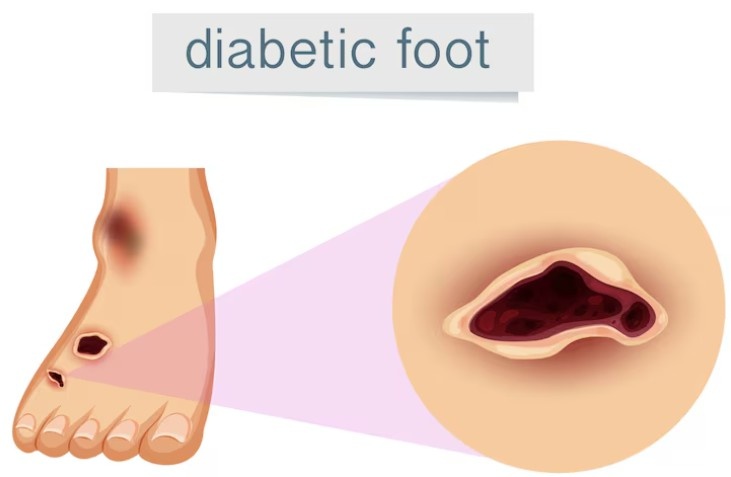Best Diabetic Foot Specialist in Noida