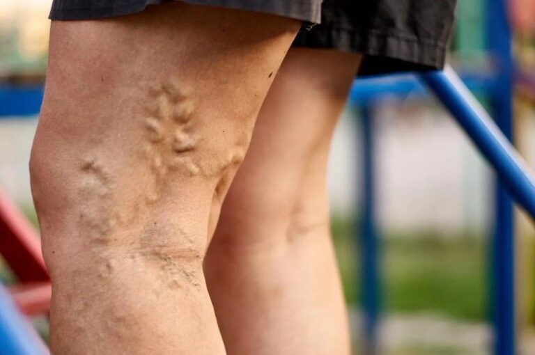 Best Varicose Veins Doctor in Noida
