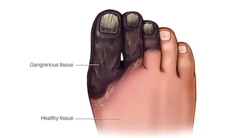 Best Gangrene Specialist in Noida Sector 79