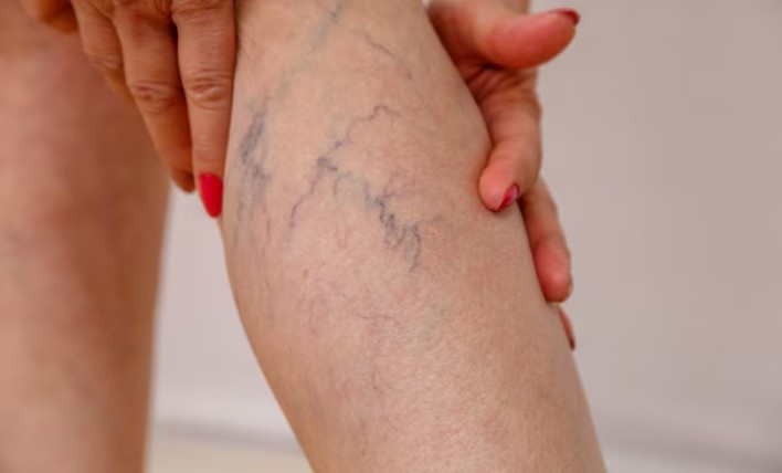 Best Varicose Vein Specialist in Noida Sector 78