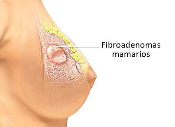Best Breast Fibroadenoma Specialist in Noida